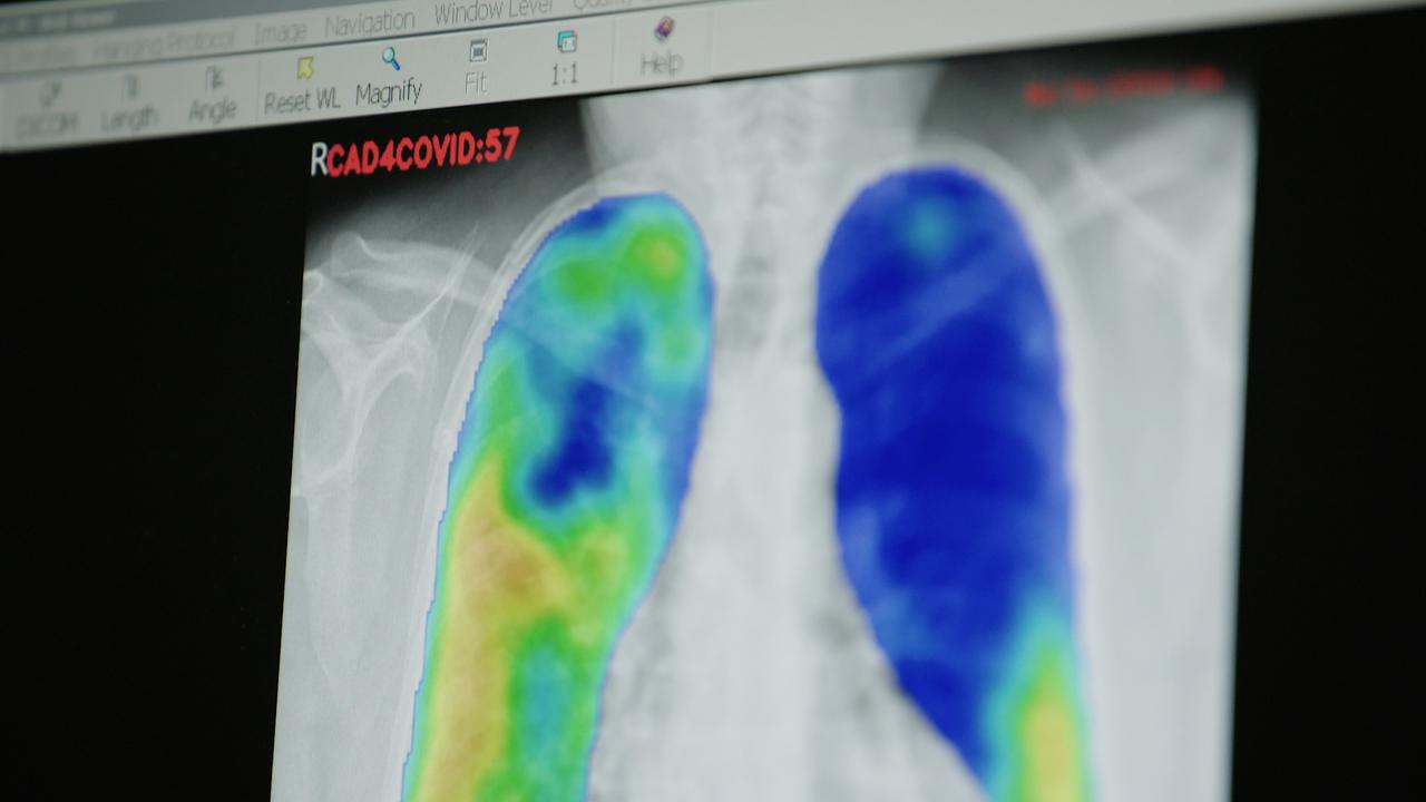 Afbeelding bij video: AI-ontwikkeling voor triage in de radiologie